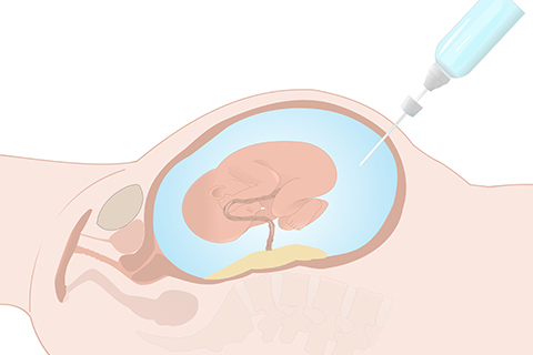 Amniocentesis illustration