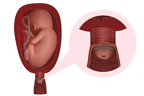 Cerclage