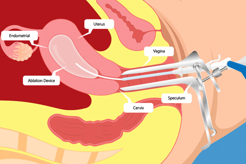 endometrial ablation illustration