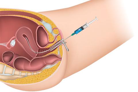 Intrauterine Insemination illustration