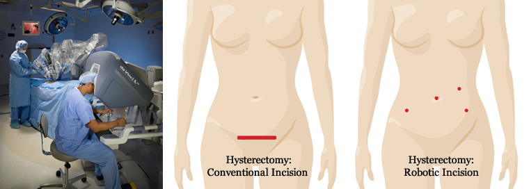Robotic Surgery | Obstetrics & Gynecology of Atlanta