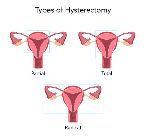 Hysterectomy Obstetrics Gynecology Of Atlanta