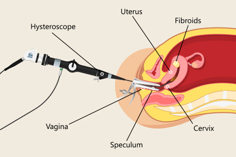 hysteroscopy illustration