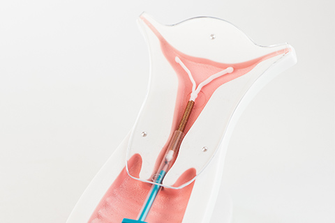 Intrauterine Device | Obstetrics & Gynecology Atlanta