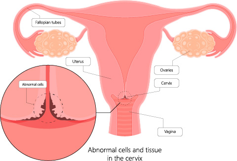 Illustration showing abnormal cells and tissue in the cervix