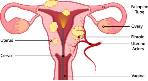 Uterus fibroid